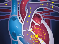 Heart disease